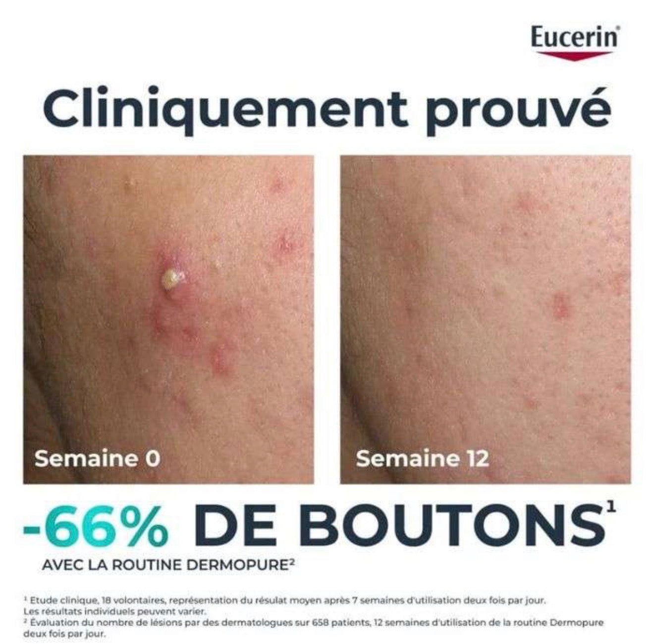EUCERIN – DermoPure Sérum Clinical Triple Action – 40ml
